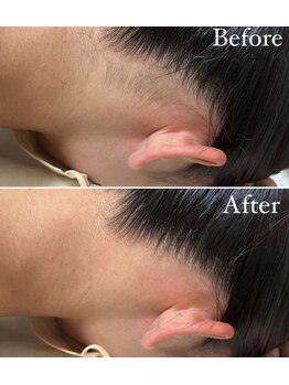 シエル 美里店(ciel)/女性に人気のうなじ脱毛！