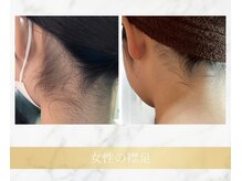 アンド エヌ(&n)/◆襟足脱毛◆