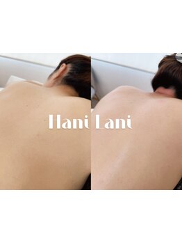 脱毛デビューにオススメのサロン