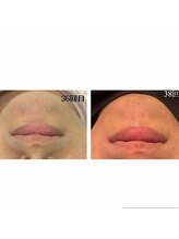 レイモード(Ray mode)/髭脱毛