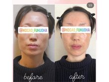 ル フラーズ(Les Fleurs)/エラ張り　食いしばり