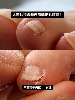 巻き爪じゅん 船橋店/千葉市中央区の巻き爪と痛み改善