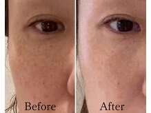 リノア 柏(Lino'a)/45歳女性/くすみ シミケア 老化