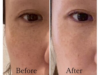 リノア 柏(Lino'a)/45歳女性/くすみ シミケア 老化