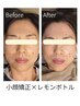【佐野希少】レモンボトル×本格小顔矯正（60分）