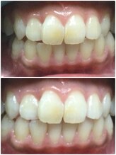 カルム(Calme)/セルフホワイトニング