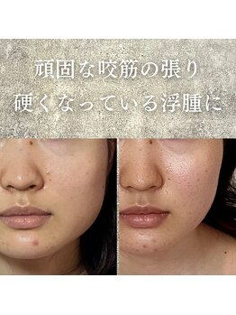 オアシス トウキョウ 川崎店(OASIS TOKYO)/サボテン美容鍼×美作矯正