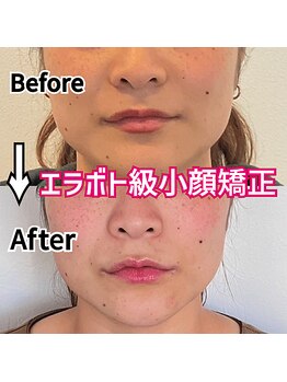 アコルデ 岡山問屋町(ACORDE)/小顔矯正ver.3