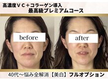 ヒトハナ(hitohana)/たるみ改善！！