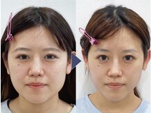美デザイン 小倉店(美.design)/☆小顔矯正+頭蓋骨矯正