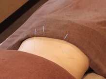 きわみ鍼灸整骨院 博多院/急な腰の痛みに