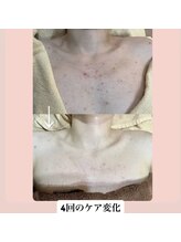 スキンハピネス(skinhappiness)/デコルテハーブピーリングケア