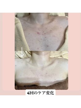 スキンハピネス(skinhappiness)/デコルテハーブピーリングケア