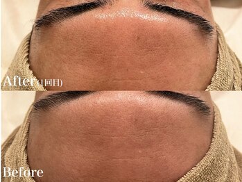 シャルム(Charme)/メンズフェイシャル♪シワケア