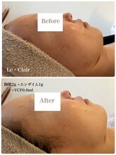 スキンセラピーサロン ル クレール(Le Clair)/Before→After