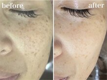 ホワイトアクア 錦糸町店(WHITE AQUA)/ララピール/くすみケア/毛穴