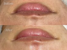 ミルタンドレス(Mille Tendresses)/つや肌ワックスフェイシャル