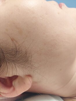 キアラ 麻布十番(Kiara)/もみあげ脱毛　