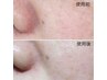 【毛穴の汚れ・うぶ毛をごっそり除去！】毛穴洗浄×顔脱毛でたまご肌に