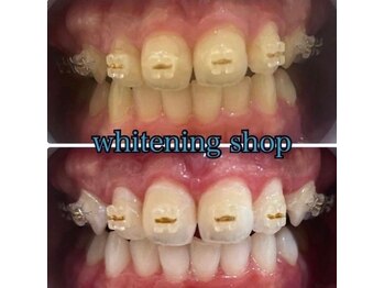 ホワイトニングショップ 高知店/矯正中でも大丈夫！◎