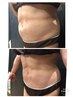 【ぽっこりお腹・ぜい肉、脇肉上半身】ウィンバック＋半身筋膜リリース80分