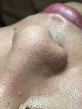 エピシアドットエヌ(epicia.N)/こんなお鼻になっていませんか?