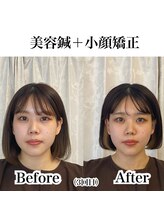 鍼グリッター 岡山本院(鍼Glitter.)/小顔矯正×美容鍼