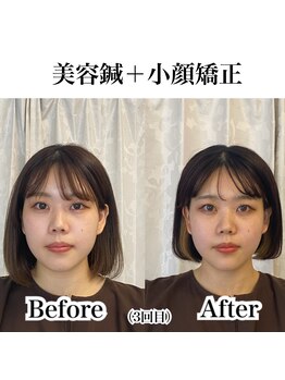 鍼グリッター 岡山本院(鍼Glitter.)/小顔矯正×美容鍼
