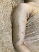 ソワン(Soin)/二の腕脂肪¨吸の術後インディバ