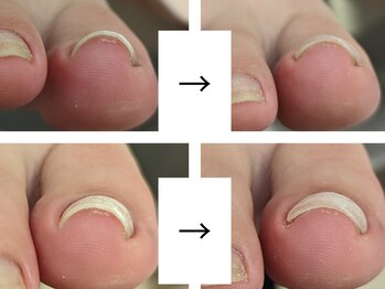 エムスラッシュ ネイル センター北店(M.SLASH)/巻いたお爪　フットケア