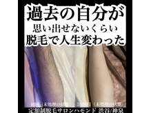 ハモンド(Hammond)/脚脱毛