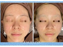 シンメトリー 銀座店/肌質改善に◎ハーブピーリング