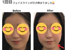 ベル/20代の方の小顔Before After