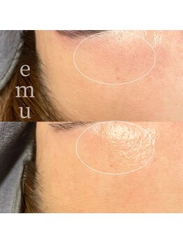 エミュ(emu)/フェイシャルwaxでツヤ爆誕！