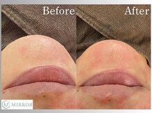 ミラー(MIRROR)/熊本市/毛穴洗浄/西熊本/くすみ