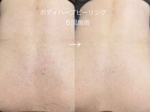 シャロル(SHALOR)/BODYハーブピーリング｜症例写真