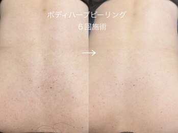 シャロル(SHALOR)/BODYハーブピーリング|症例写真