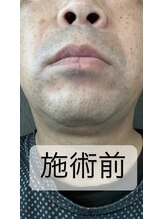 ゴッド(GOD)/髭脱毛