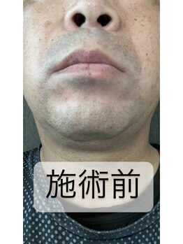 ゴッド(GOD)/髭脱毛