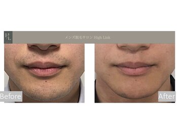 ハイリンク(High Link)/《ひげ脱毛》before→after