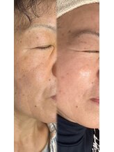 エコム(ECOM)/OTHELLO肌質改善コース