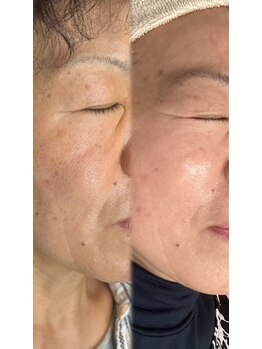 エコム(ECOM)/OTHELLO肌質改善コース