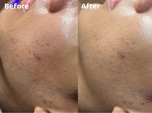 クリスタルビューティ 渋谷/【LHALALAララピール】