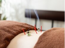 はな鍼灸院/台座灸