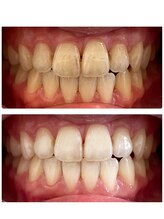 クリア(Clear)/1本1本しっかりきれいに♪