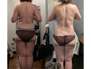 ミイシャ はなれ(miisha)/脂肪分解導入剤、セルライトゼロ