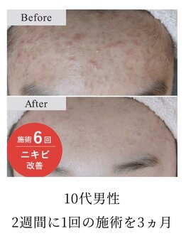 クラティス 伊那店(CRATIS)/思春期ニキビ