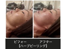 ジェイアンドエス トータルビューティー(J&S Total Beauty)/ハーブピーリング