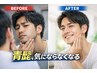 【メンズ毛穴洗浄吸引+ヒゲ/顔脱毛(全顔)】繰り返す肌荒れ、ニキビケアに