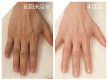 キレイテ 上野店/40代/4回目【東京ハンドケア】